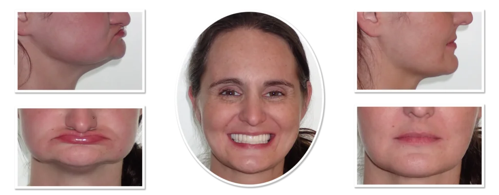 Zygomatic Dental Implants Before and After