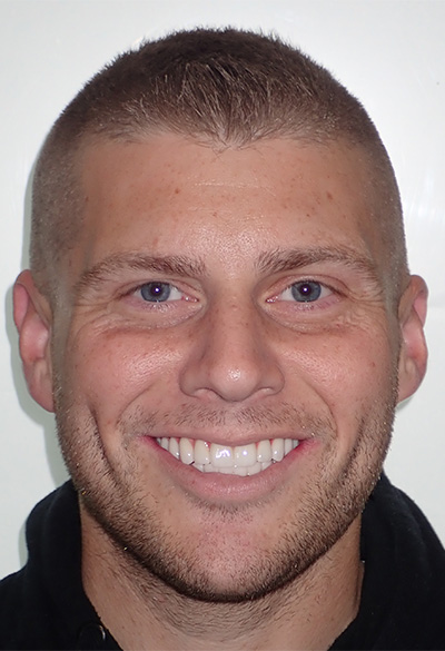 B&A-Face-Adam-After