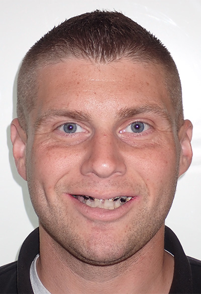 B&A-Face-Adam-Before