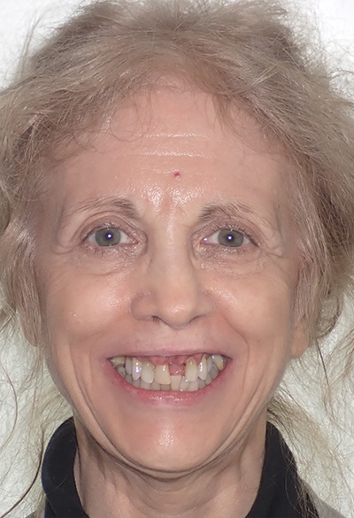 B&A-Face-Alex-Before