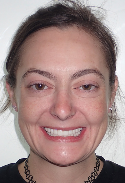 B&A-Face-Amanda-After