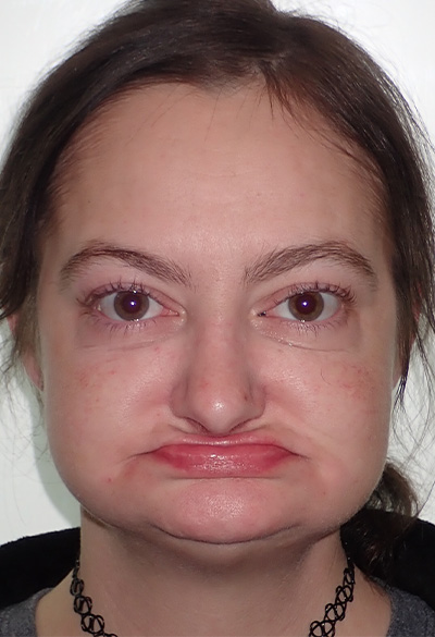 B&A-Face-Amanda-Before