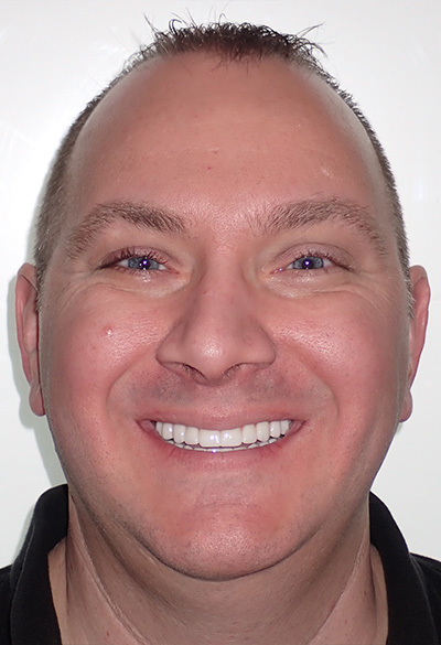B&A-Face-Andrew-After