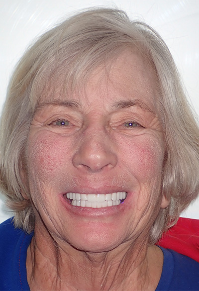 B&A-Face-Ann-After