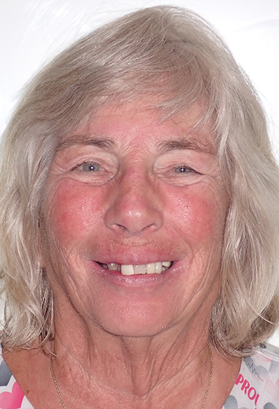B&A-Face-Ann-Before