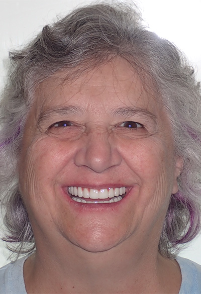 B&A-Face-Barb-After