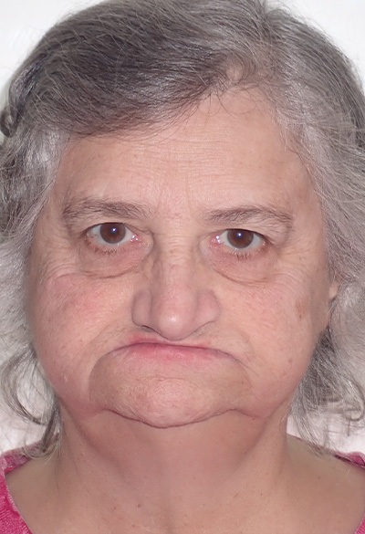 B&A-Face-Barb-Before