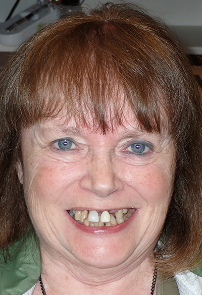 B&A-Face-Cheryl 2-Before