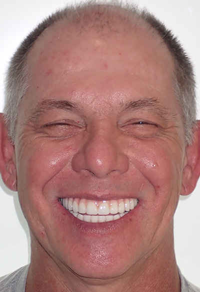 B&A-Face-Jeff-After