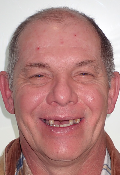 B&A-Face-Jeff-Before