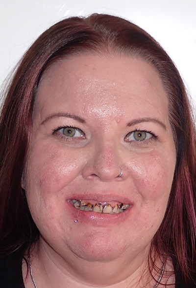 B&A-Face-Jessica-Before