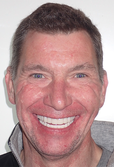 B&A-Face-Joe 2-After