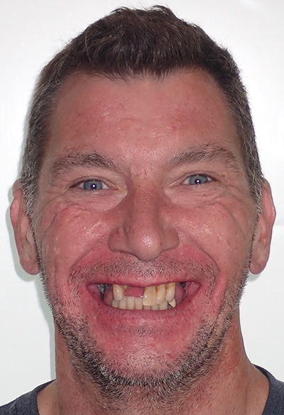 B&A-Face-Joe 2-Before B&A-Face-Joe 2-Before