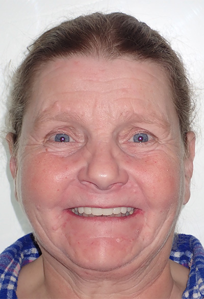 B&A-Face-Kathleen-After