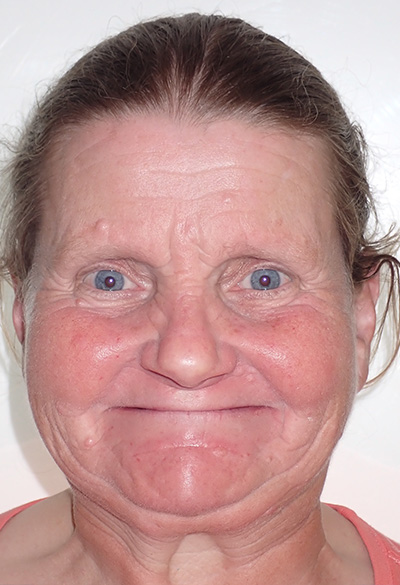 B&A-Face-Kathleen-Before