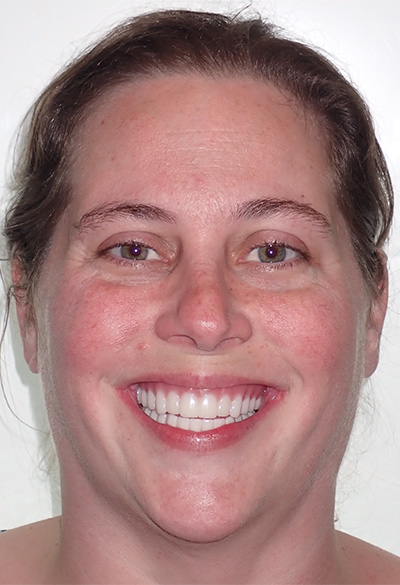 B&A-Face-Kelly-After