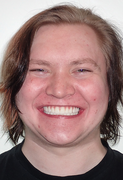 B&A-Face-Mason-After