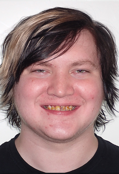 B&A-Face-Mason-Before