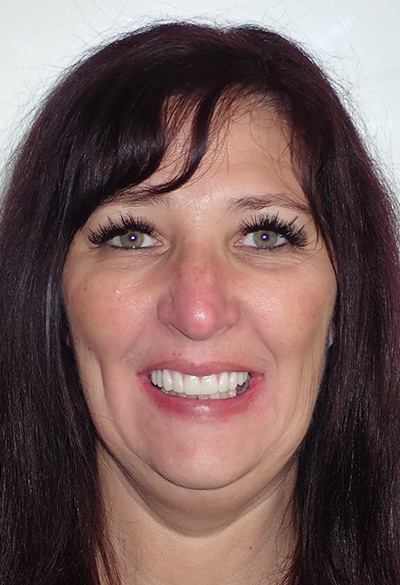 B&A-Face-Wendy-After