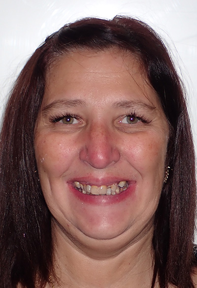 B&A-Face-Wendy-Before B&A-Face-Wendy-Before