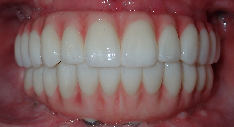 B&A-Teeth-Adam-After