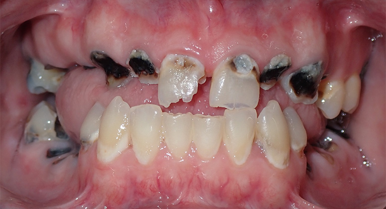 B&A-Teeth-Adam-Before