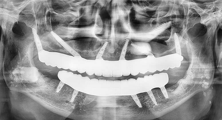B&A-Teeth-Xray-Dave 3-After