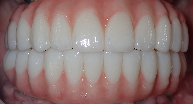 B&A-Teeth-Alex-After