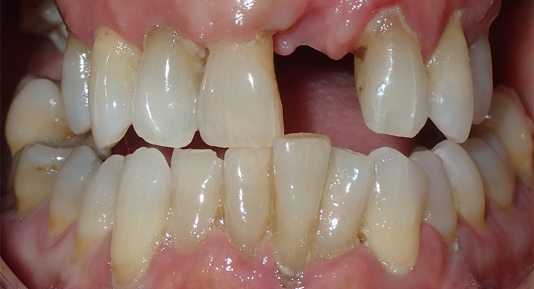 B&A-Teeth-Alex-Before