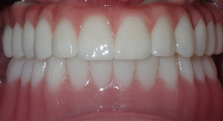 B&A-Teeth-Amanda 2-After