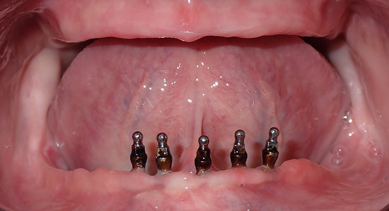 B&A-Teeth-Amanda 2-Before