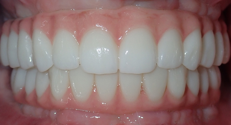 B&A-Teeth-Amanda-After