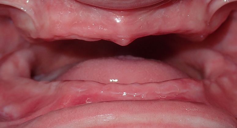 B&A-Teeth-Amanda-Before