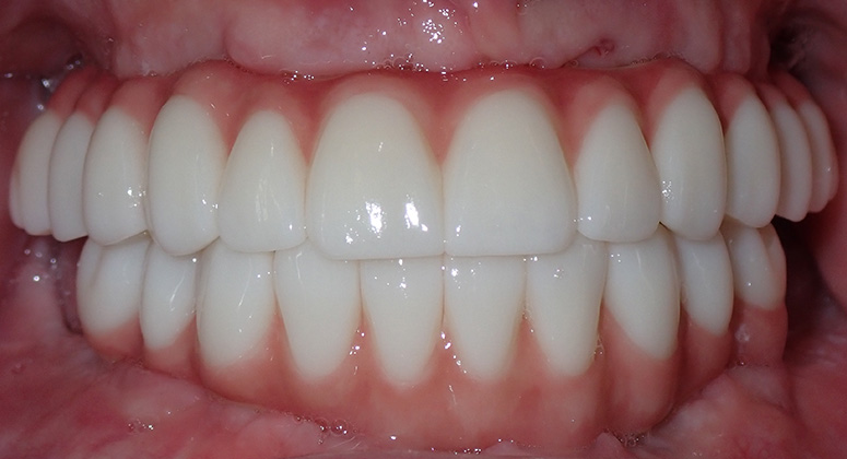 B&A-Teeth-Andrew-After