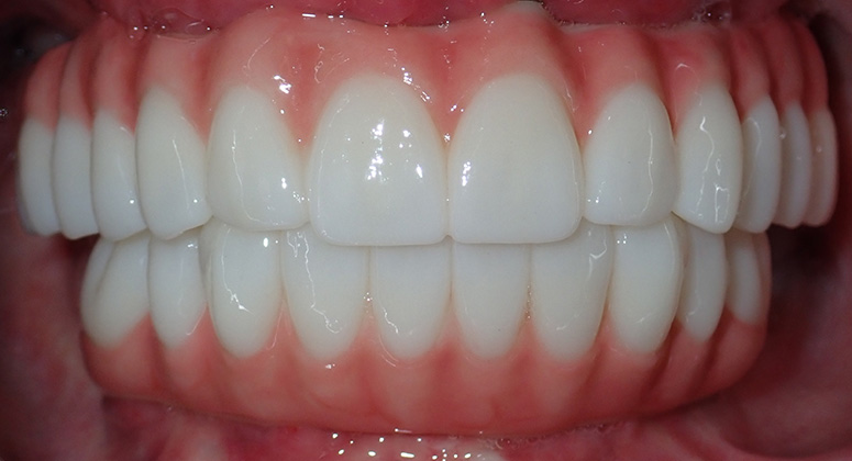 B&A-Teeth-Ann-After