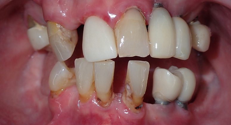 B&A-Teeth-Ann-Before
