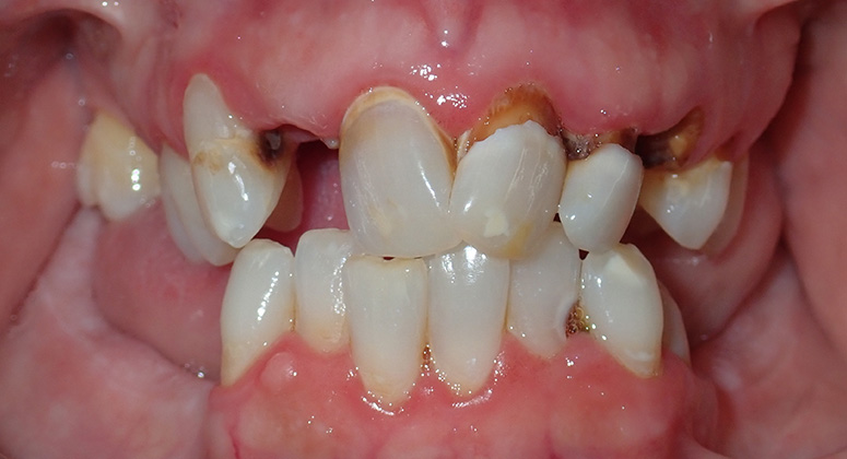 B&A-Teeth-Beth-Before