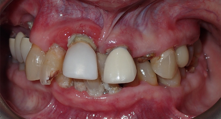 B&A-Teeth-Chery 2-Before