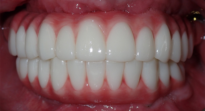 B&A-Teeth-Cheryl 2-After