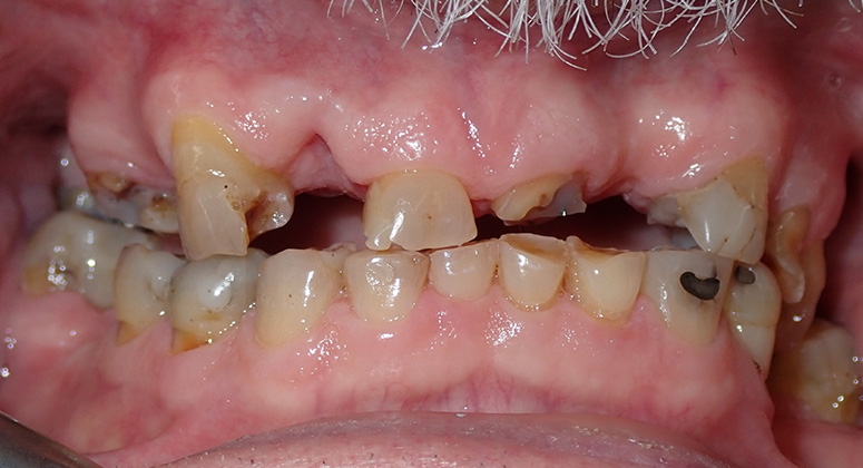 B&A-Teeth-Dave 3-Before