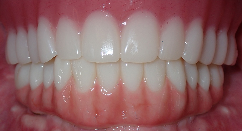 B&A-Teeth-Don-After