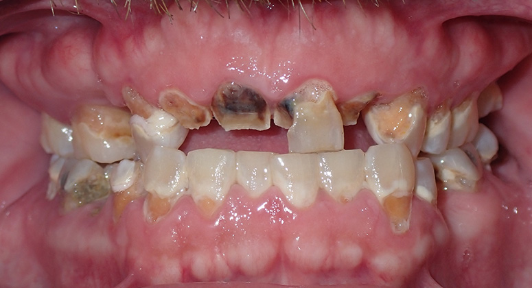 B&A-Teeth-Don-Before