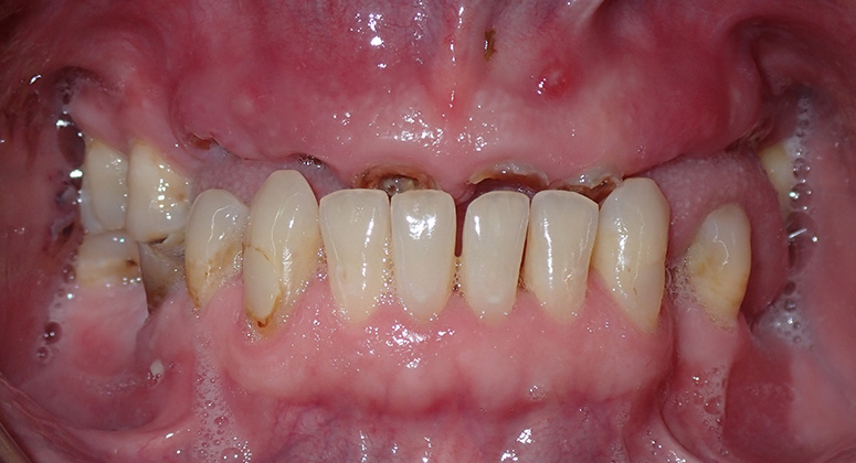 B&A-Teeth-Ian-Before