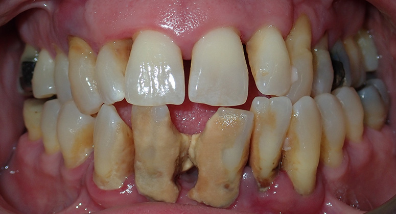 B&A-Teeth-James-Before