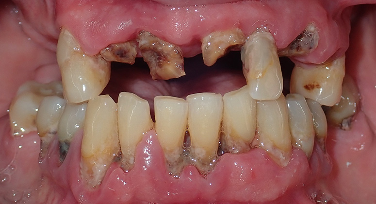 B&A-Teeth-Jeff-Before