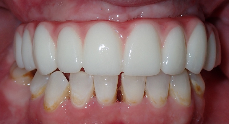 B&A-Teeth-Jessica-After