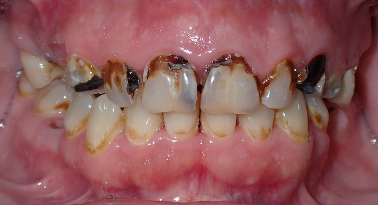 B&A-Teeth-Jessica-Before