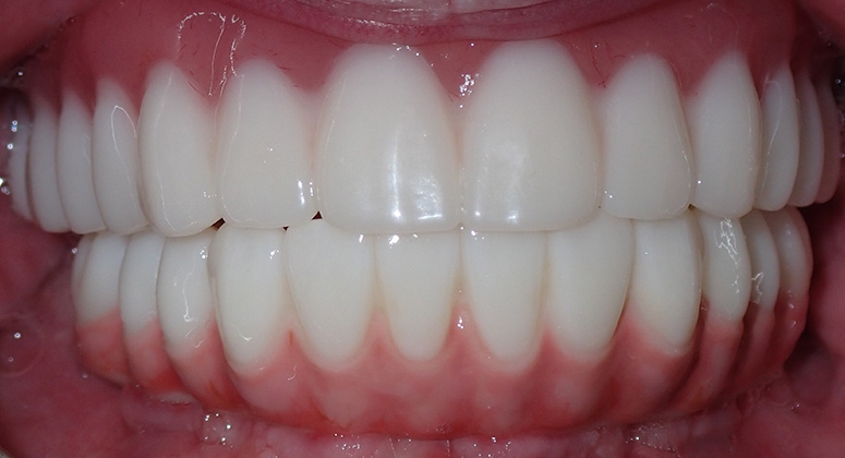B&A-Teeth-Joe 2-After