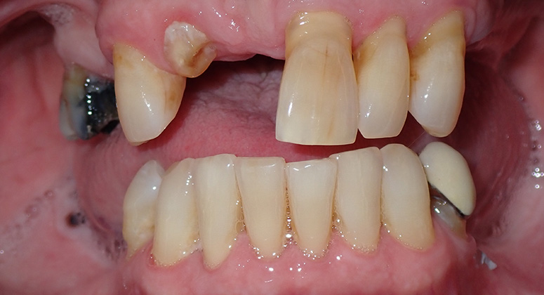 B&A-Teeth-Joe 2-Before B&A-Teeth-Joe 2-Before
