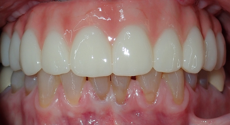 B&A-Teeth-Kathleen-After